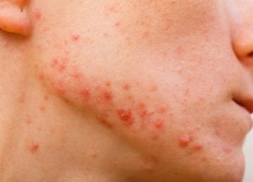 25769385 - acne skin because the disorders of sebaceous glands productions