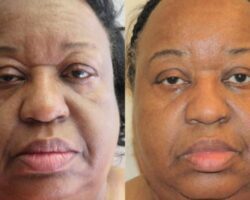 PDO Thread Lift Asymmetrical Smile & Eyes