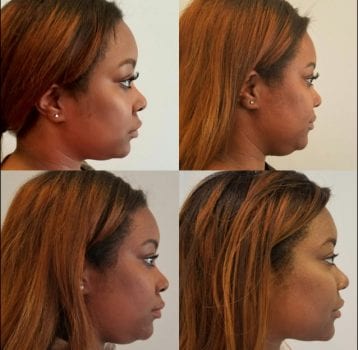kybella kybella