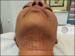 kybella kybella