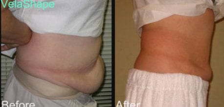 Tummy Fat Removal with VelaShape  Non-surgical Body Contouring