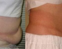 Laser Treatments Tightening / Skin Rejuvenation