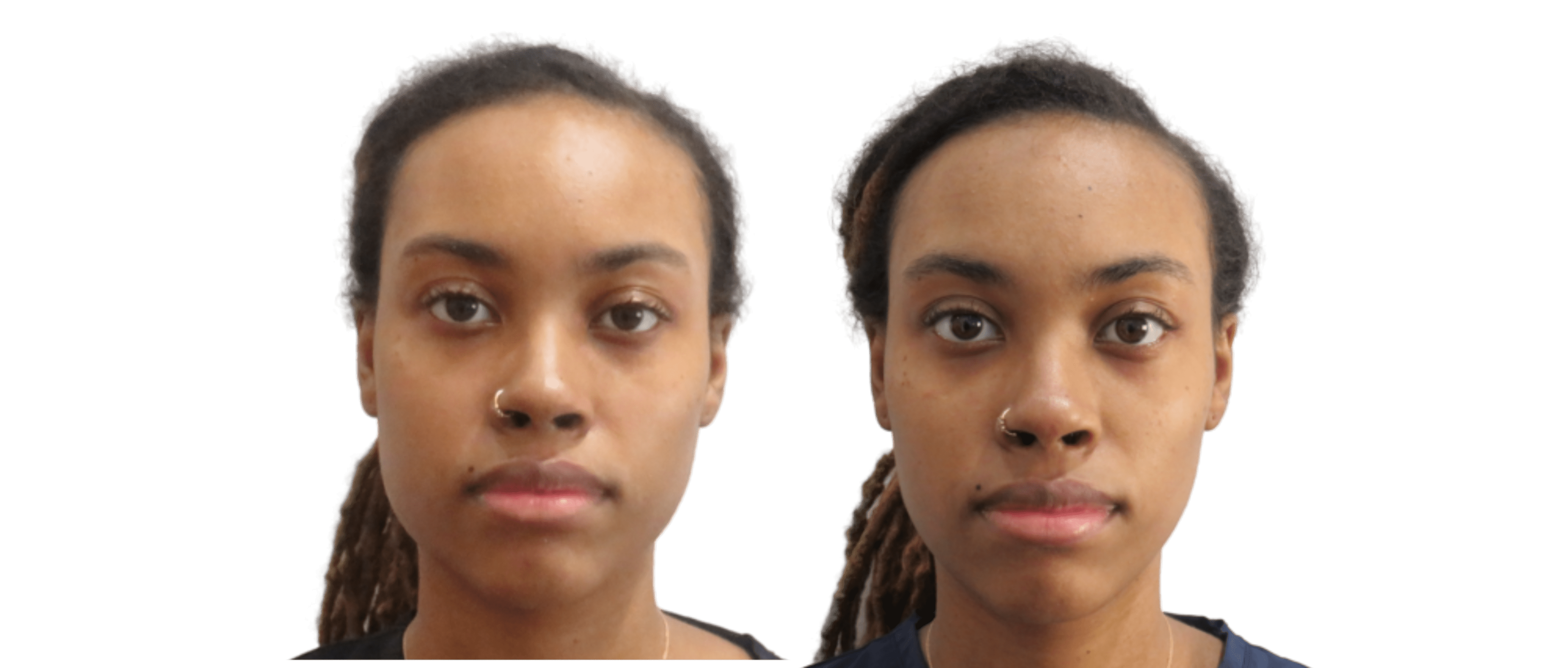 TMJ Pain & Jaw Slimming TMJ Pain & Jaw Slimming