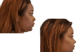 Kybella_clipped_rev_1-1024x793-300x200 Kybella_clipped_rev_1-1024x793-300x200