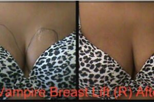 vampire_breastlift-300x200 vampire_breastlift-300x200